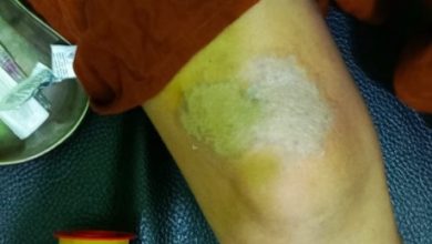 IRT di Toboali Disiram Air Keras oleh Suaminya Sendiri 9 IMG 20240207 WA0066